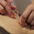 鍼治療